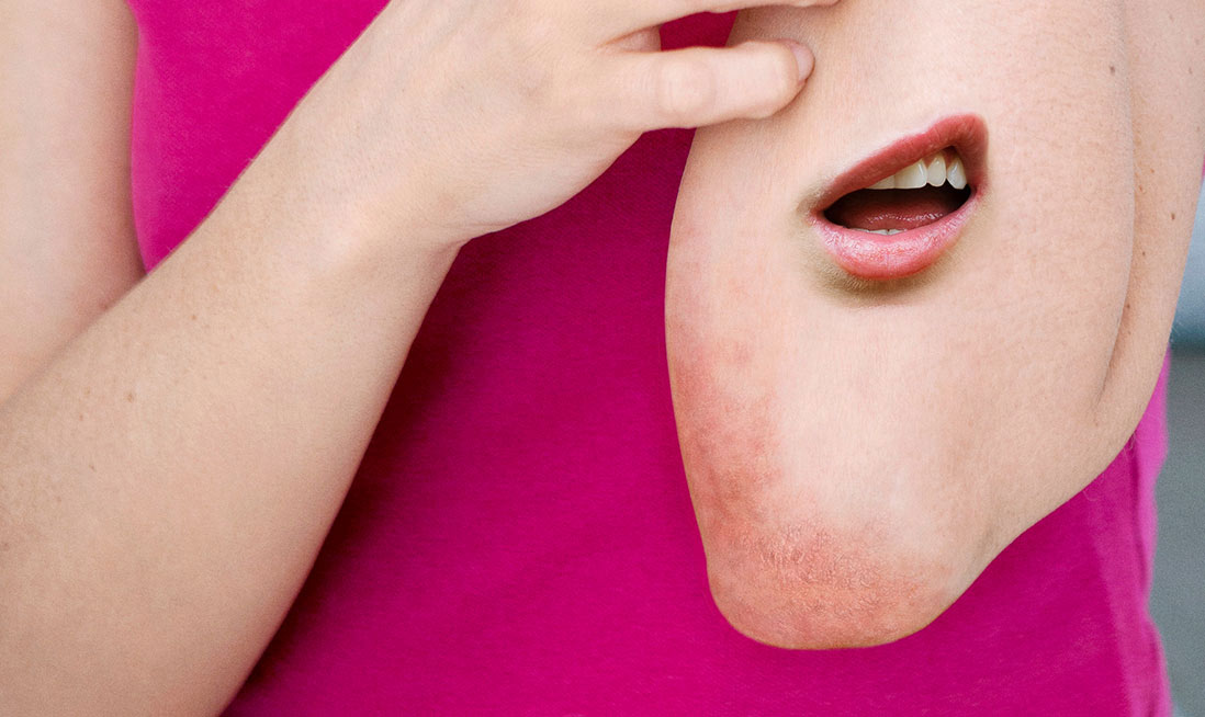 Treatment for Plaque Psoriasis (PsO)